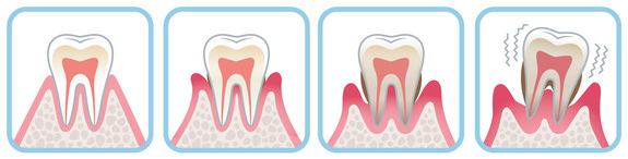 歯周病イメージ２